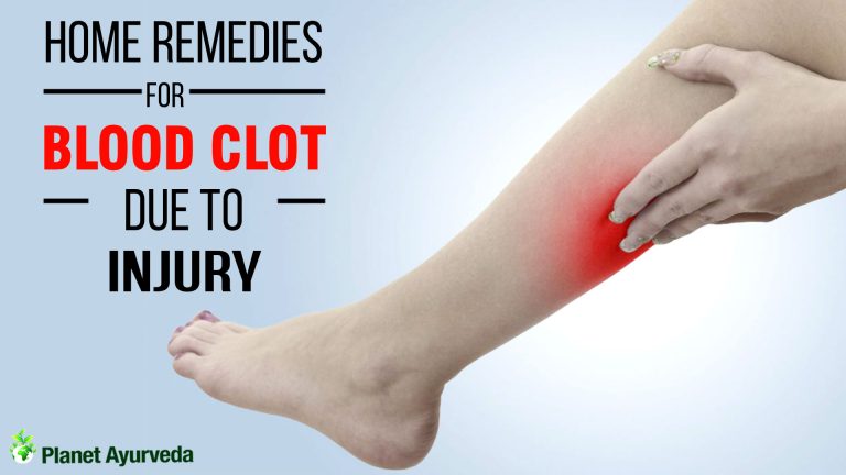 Home Remedies for Blood Clot Due to Injury