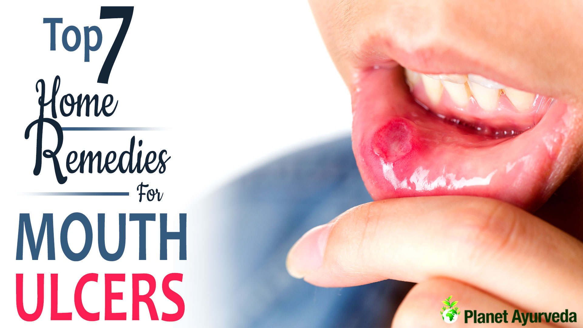 Top 7 Home Remedies For Mouth Ulcers 