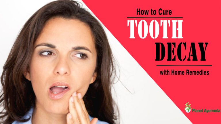 How to Cure Tooth Decay with Home Remedies