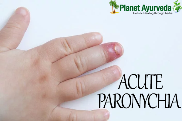 Acute Paronychia Treatment
