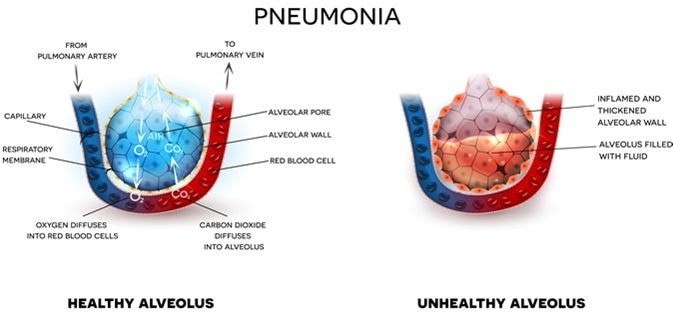 natural-remedies-for-chronic-eosinophilic-pneumonia-planet-ayurveda