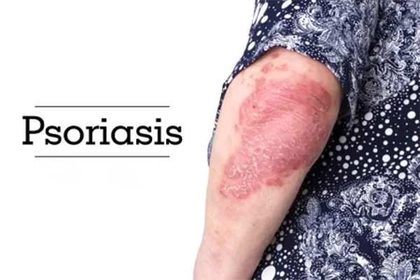 Psoriasis