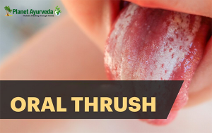 Symptoms Of Oral Thrush Archives Planet Ayurveda