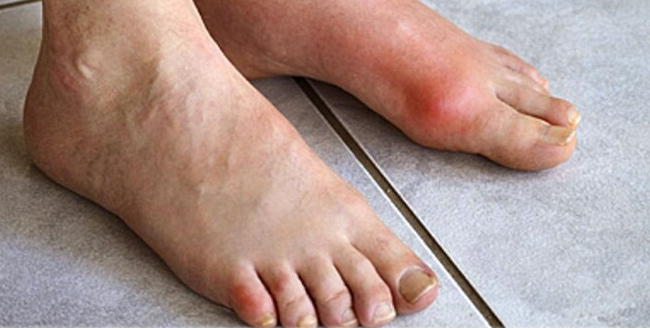 treatment of gout