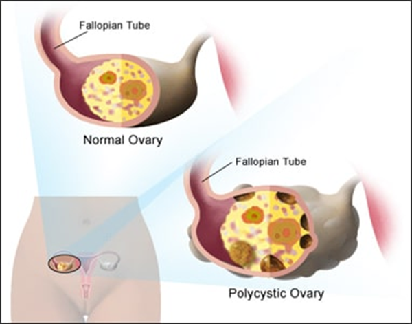 PCOD (Polycystic Ovarian Disease)