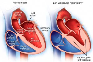 Left Ventricular(LV) Hypertrophy Treatment in Ayurveda - Planet Ayurveda