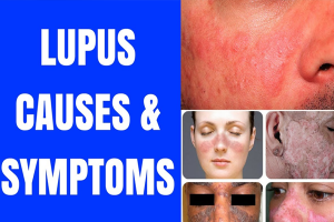 natural remedies for lupus Archives - Planet Ayurveda