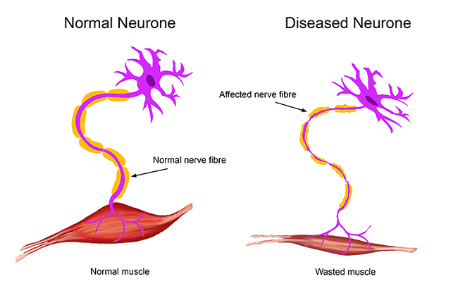 Ayurvedic Treatment For Motor Neurone Disease MND Planet Ayurveda