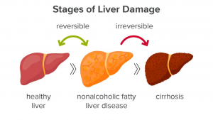 Ayurvedic Treatment of Nonalcoholic Fatty Liver Disease (NAFLD)