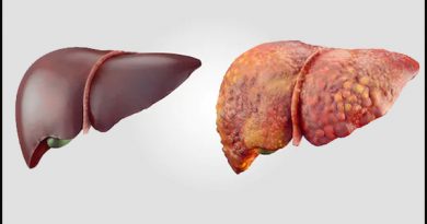 Liver Cirrhosis