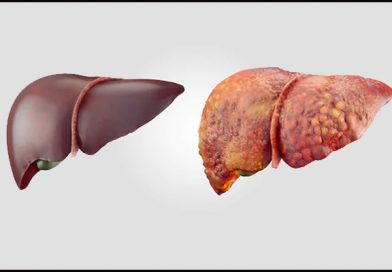 Liver Cirrhosis