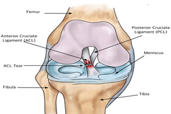 Anterior cruciate ligament tear