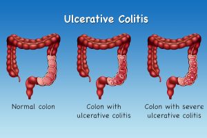 How Ayurveda Deals with Ulcerative Colitis Patients?