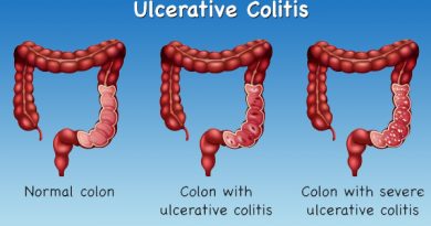 Ulcerative Colitis