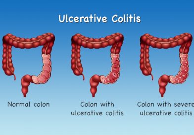 Ulcerative Colitis