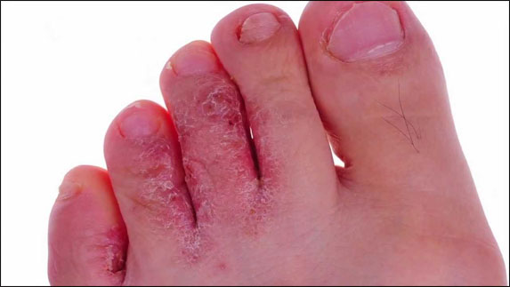 Tinea pedis or athlete’s foot 