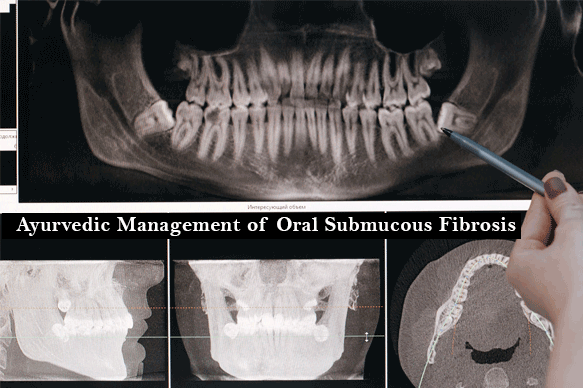 Ayurvedic Management of Oral Submucous Fibrosis