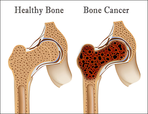 Bone Cancer