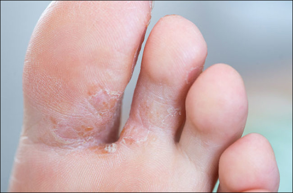 Alternative Treatment For Athlete S Foot Or Tinea Pedis