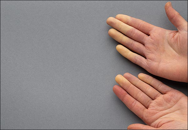 Raynaud’s phenomenon