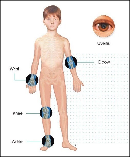 juvenile idiopathic arthritis