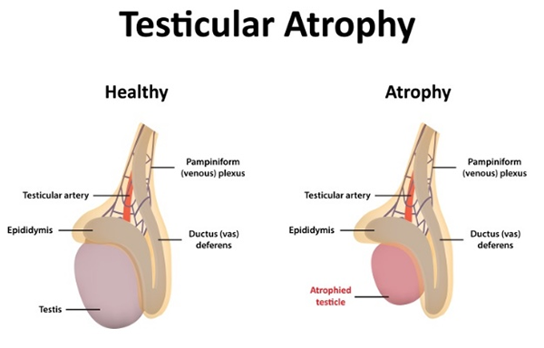 Testicular Atrophy