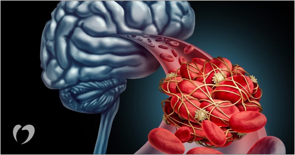 Transient Ischemic Attack