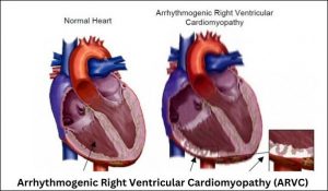 Symptoms of Arrhythmogenic right ventricular cardiomyopathy Archives ...