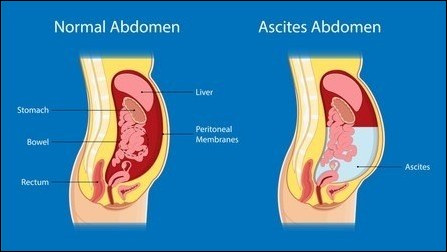 Ascites