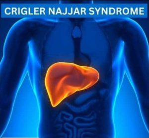 Crigler Najjar Syndrome Treatment with Herbal Remedies