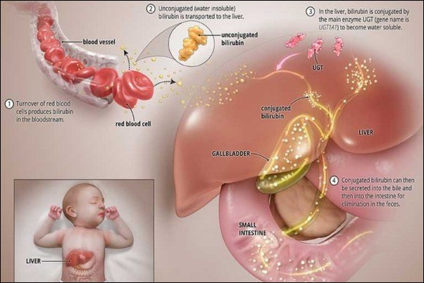 Crigler najjar syndrome