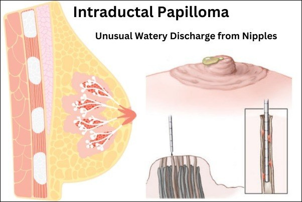 Intraductal Papilloma
