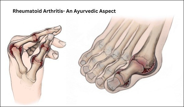 Rheumatoid Arthritis 