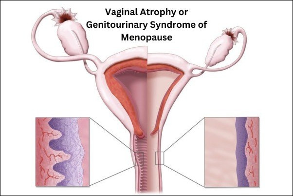 Vaginal Atrophy or Genitourinary Syndrome of Menopause