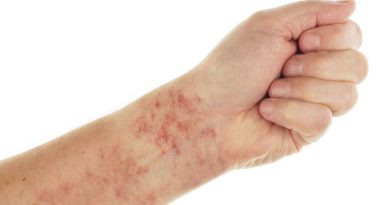 Symptoms of Immune Thrombocytopenia Purpura