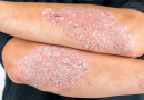 Psoriasis, Symptoms, Causes, Types and Herbal Remedies