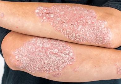 Psoriasis, Symptoms, Causes, Types and Herbal Remedies