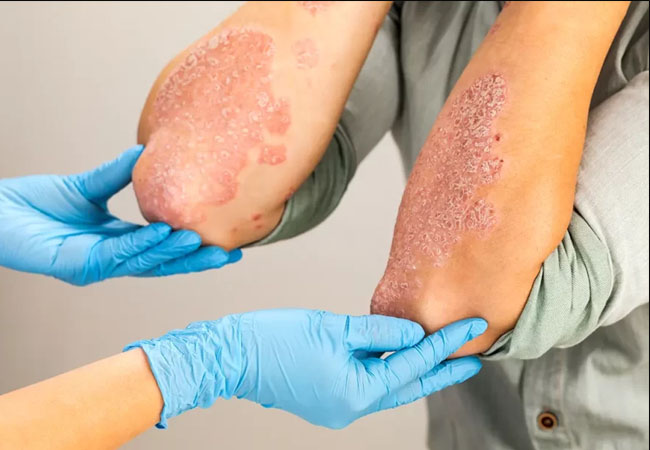 psoriasis