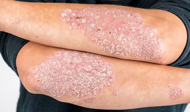 Psoriasis, Symptoms, Causes, Types and Herbal Remedies