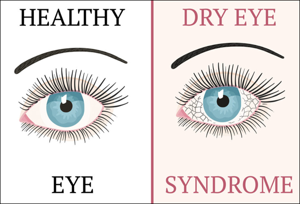 Dry Eye Syndrome, Causes of Dry Eye Syndrome, Signs and Symptoms, Ayurvedic View And Management, Herbal Remedies for Dry Eye Syndrome, Eye Care, Eye Syndrome, Ayurvedic Treatment for Dry Eye Syndrome, Sjogren syndrome