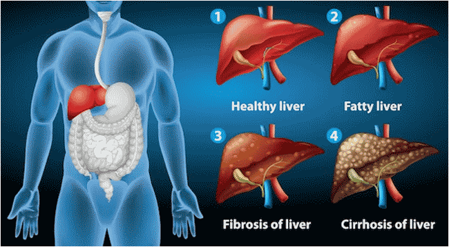 liver cirrhosis