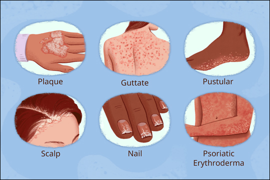 Psoriasis, Types of Psoriasis, Causes of Psoriasis, Diagnosis of Psoriasis, Chronic Skin, Ayurvedic Treatment for Psoriasis, Herbal Remedies for Psoriasis