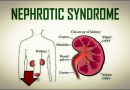 Nephrotic syndrome