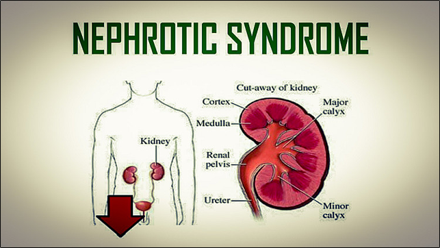 Nephrotic syndrome 